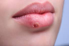 drugs-for-herpes-labialis-oral-herpes-market