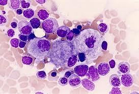 gaucher-disease-market