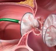 global-cardiovascular-prosthetic-market