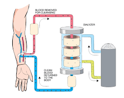global-hemodialysis-concentrate-market