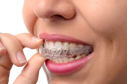 invisalign-system-sales-market
