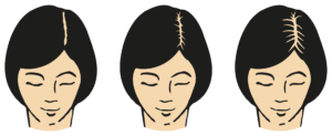 Alopezie_Frau-300x123 Neue Minoxidil-Lösung gegen Haarausfall