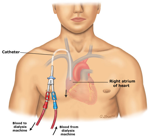 global hemodialysis bloodline systems market