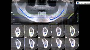 global dental cbct market