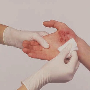 global moist wound dressings market