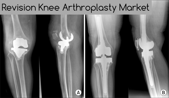 Revision Knee Arthroplasty Market ,