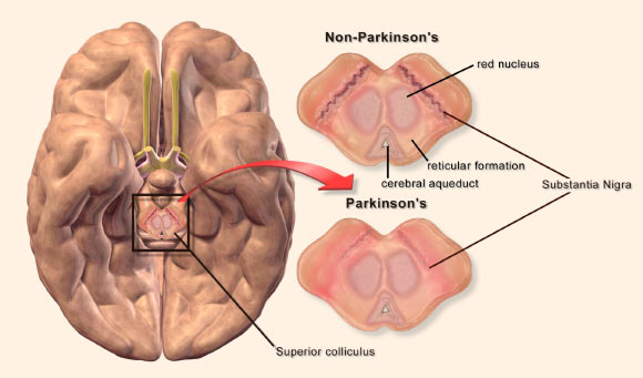 Parkinsons-Disease