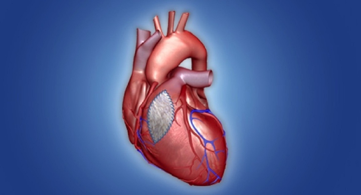 Congenital Heart Defect Repair Industry