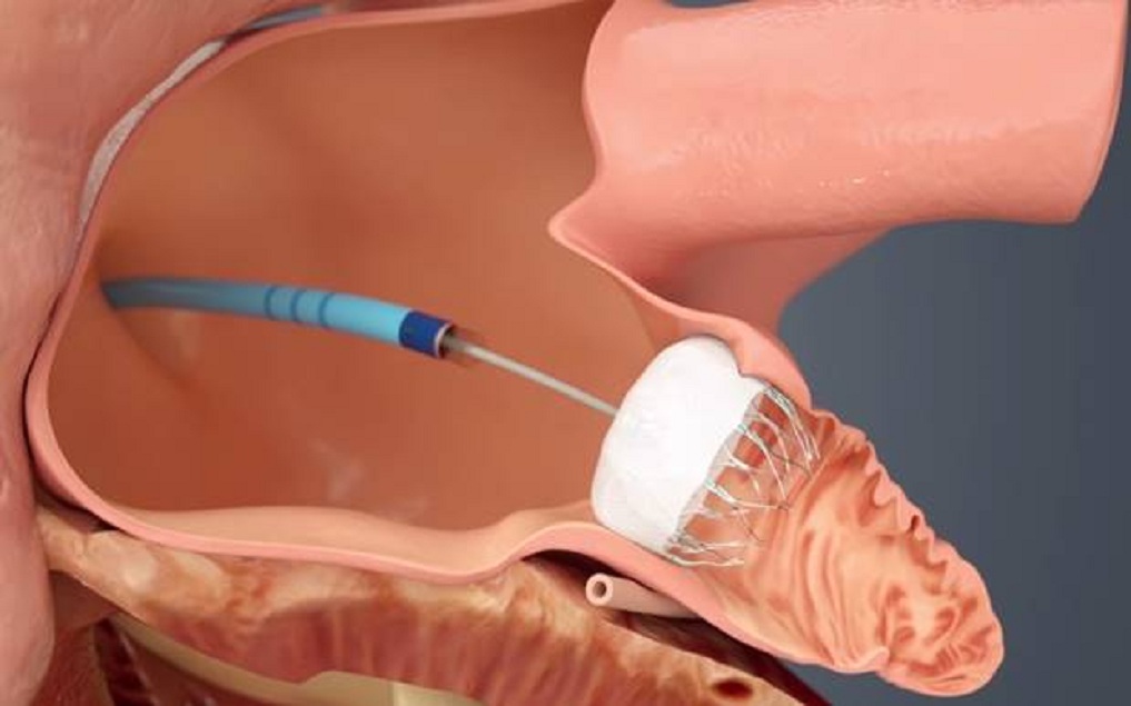 Structural Heart Closure Devices