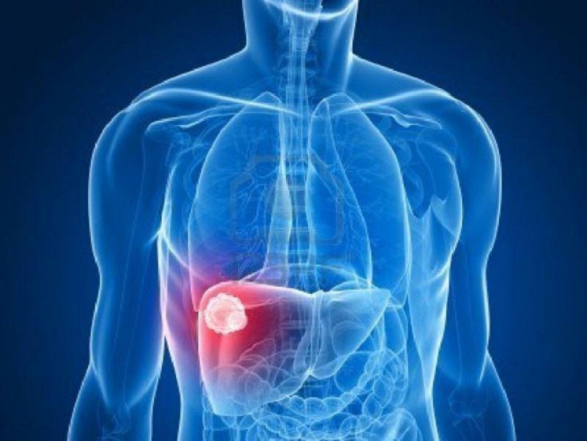Tumor Ablation
