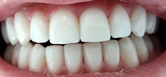 Dental Veneers market