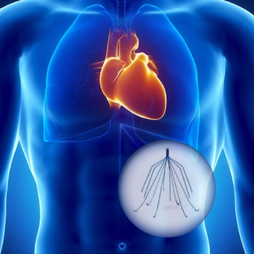 Inferior Vena Cava (IVC) Filters