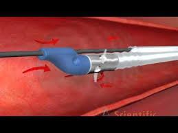 Mechanical-Thrombectomy-Devices