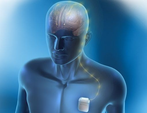 Neurostimulation Devices