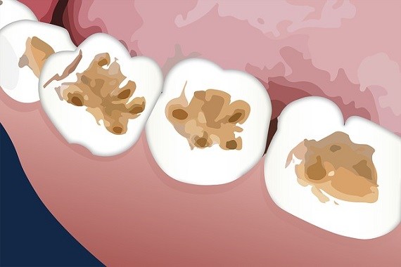 Dental Restorative Supplies Market